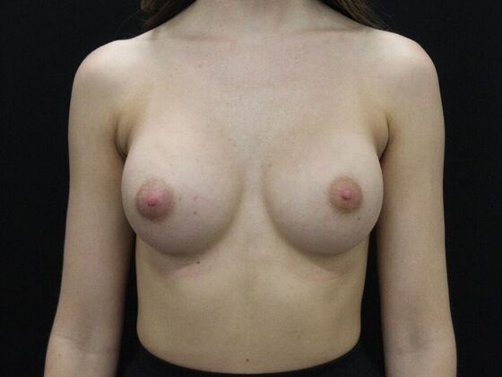 Breast Augmentation Case 100 - After