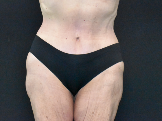 Abdominoplasty Case 18 - After