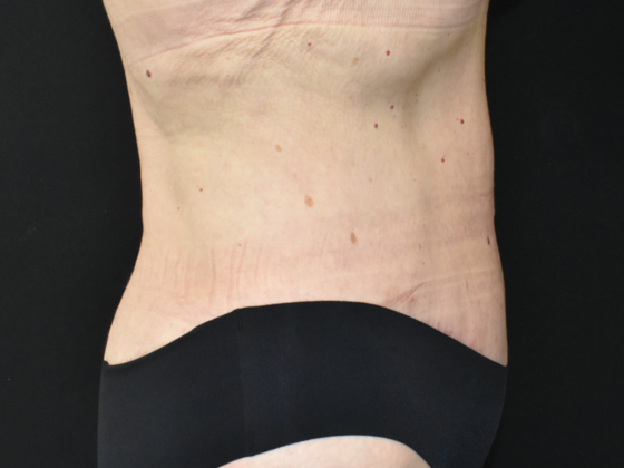 Abdominoplasty: Case 18 - After
