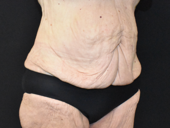 Abdominoplasty: Case 18 - Before
