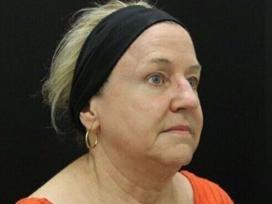 Face & Neck Lifts Case 45 - Before