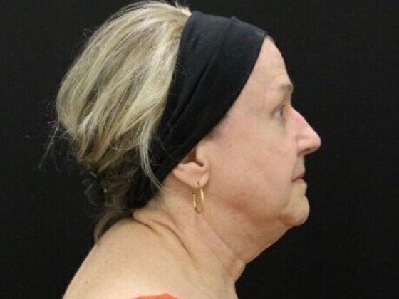 Face & Neck Lifts: Case 45 - Before