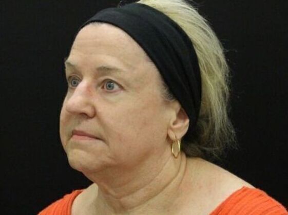 Face & Neck Lifts: Case 45 - Before