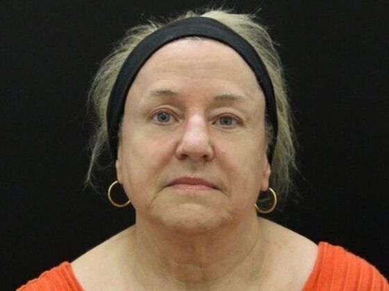 Face & Neck Lifts: Case 45 - Before