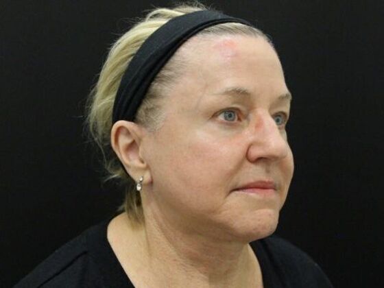 Face & Neck Lifts Case 45 - After