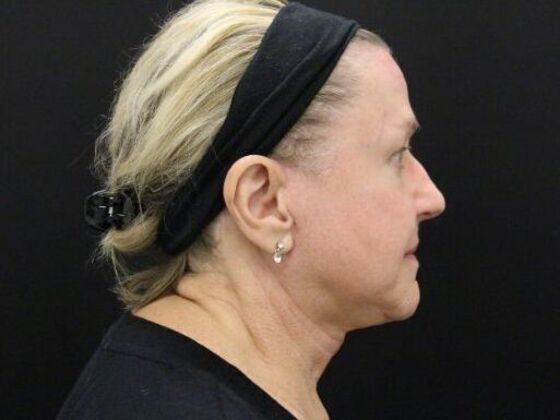 Face & Neck Lifts: Case 45 - After