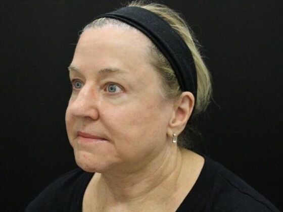 Face & Neck Lifts: Case 45 - After