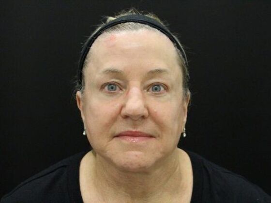 Face & Neck Lifts: Case 45 - After