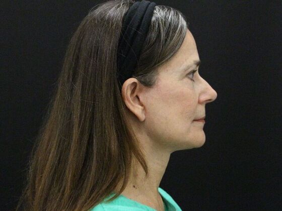 Face & Neck Lifts Case 46 - After