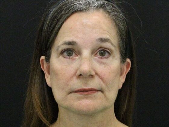 Face & Neck Lifts: Case 46 - After