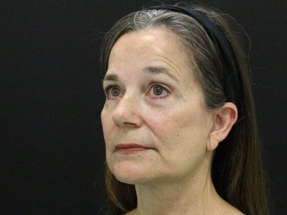 Face & Neck Lifts: Case 46 - After