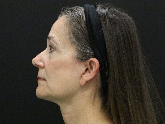 Face & Neck Lifts: Case 46 - After