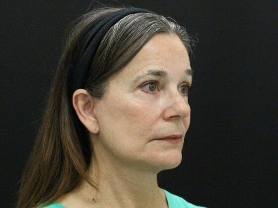 Face & Neck Lifts: Case 46 - After