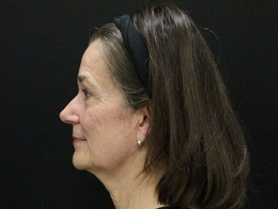 Face & Neck Lifts: Case 46 - Before
