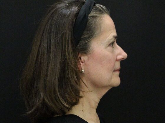 Face & Neck Lifts Case 46 - Before