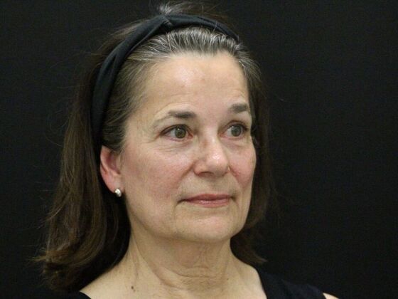 Face & Neck Lifts: Case 46 - Before