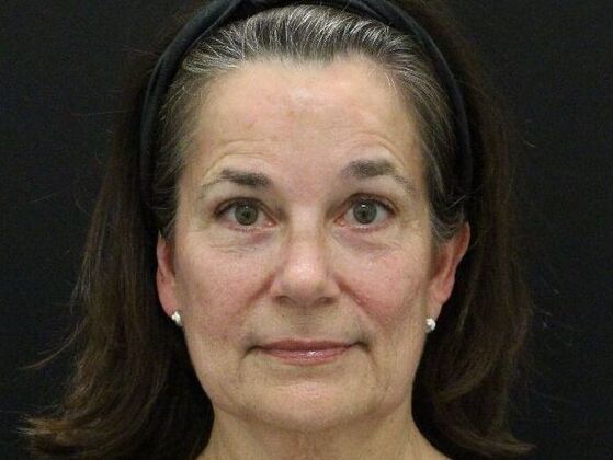 Face & Neck Lifts: Case 46 - Before