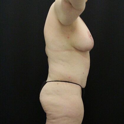 Tummy Tuck: Case 72 - After