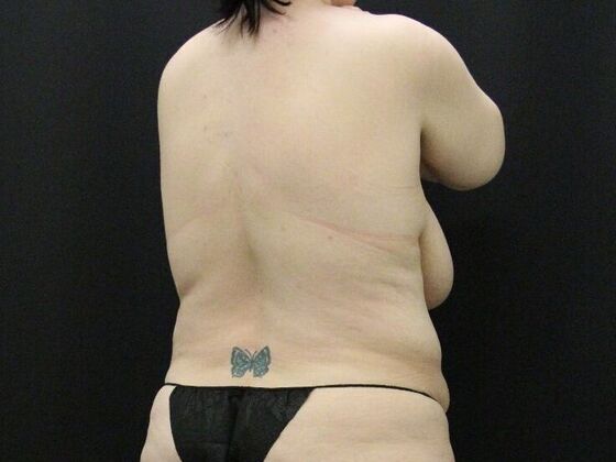 Liposuction: Case 34 - Before