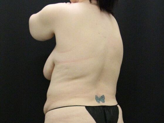 Liposuction: Case 34 - Before