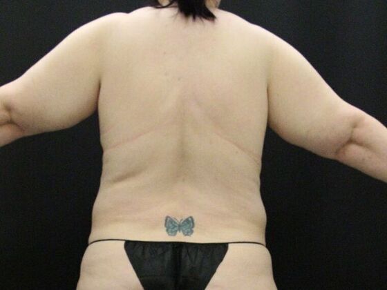 Liposuction: Case 34 - Before