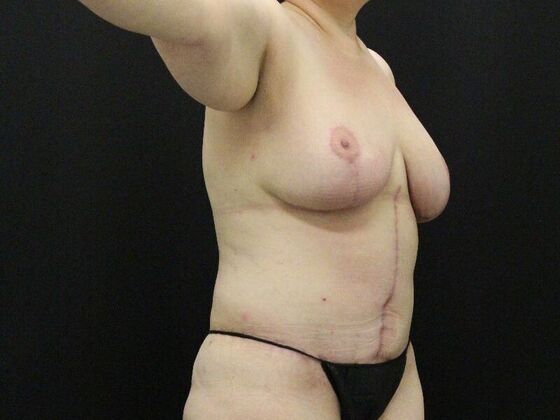 Liposuction: Case 34 - After