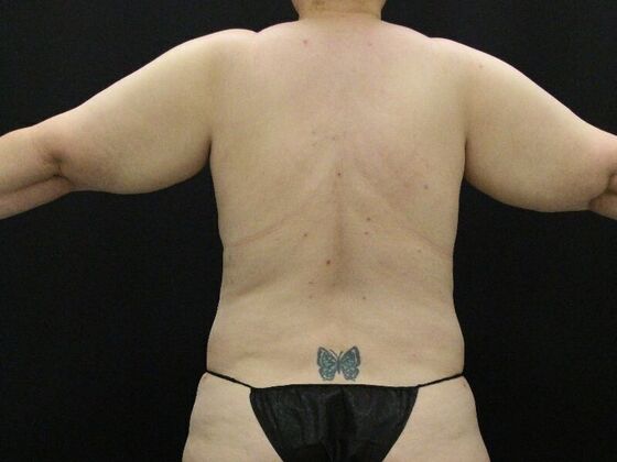 Liposuction: Case 34 - After