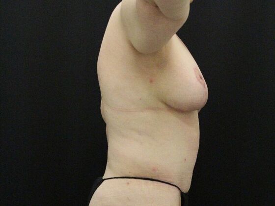 Liposuction Case 34 - After