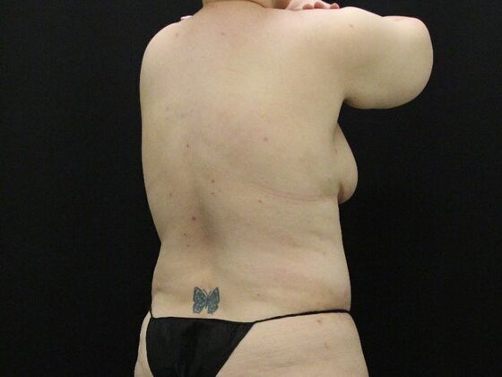 Liposuction: Case 34 - After