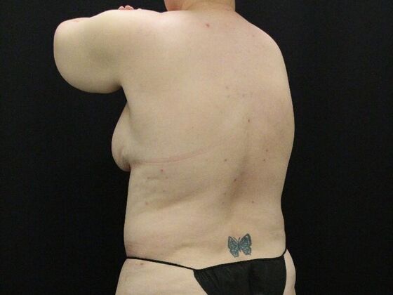 Liposuction: Case 34 - After