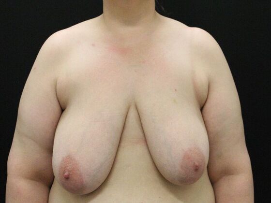 Breast Reduction Case 29 - Before