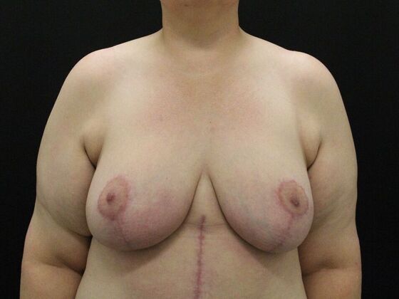 Breast Reduction Case 29 - After