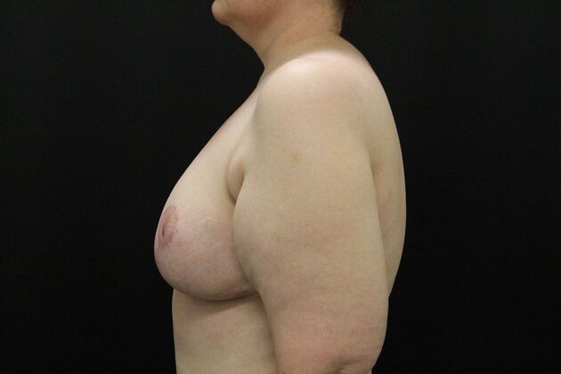 Breast Reduction: Case 29 - After