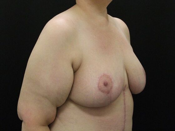 Breast Reduction: Case 29 - After