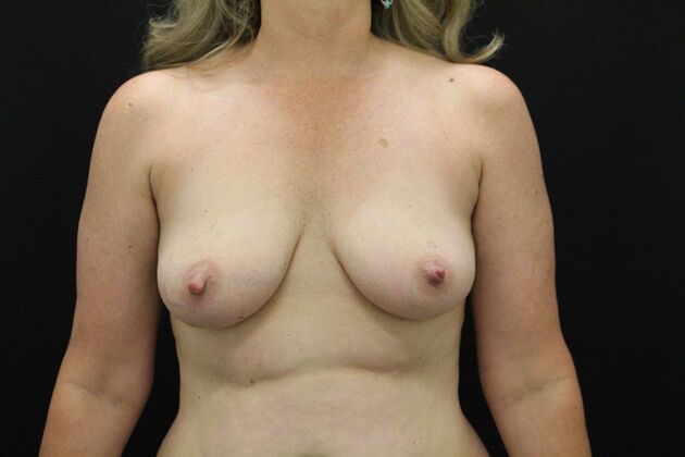 Breast Lift/Breast Lift Augmentation Case 60 - Before