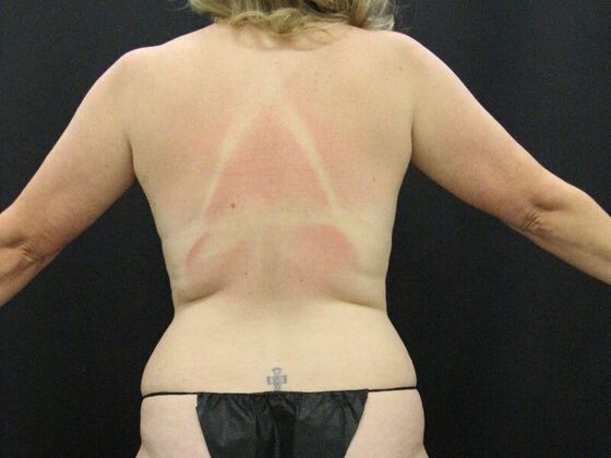 Tummy Tuck: Case 73 - Before