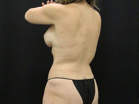 Tummy Tuck: Case 73 - After