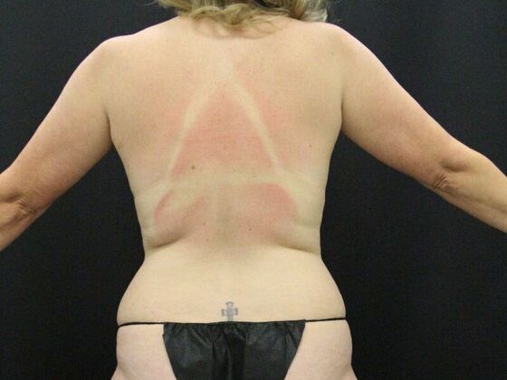 Liposuction: Case 35 - Before