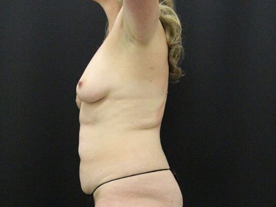 Liposuction: Case 35 - Before