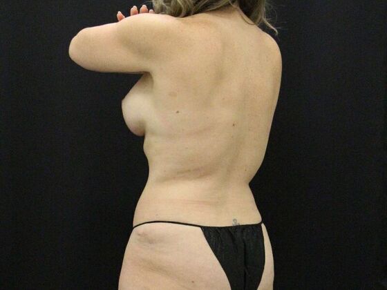 Liposuction: Case 35 - After