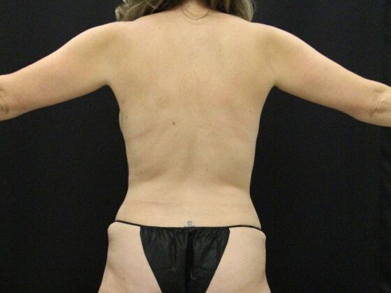 Liposuction: Case 35 - After