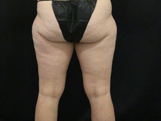 Thigh Lift Case 9 - Before