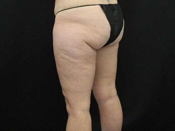 Thigh Lift: Case 9 - Before