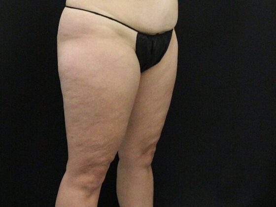 Thigh Lift: Case 9 - Before