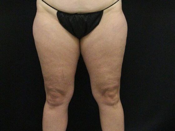 Thigh Lift: Case 9 - Before