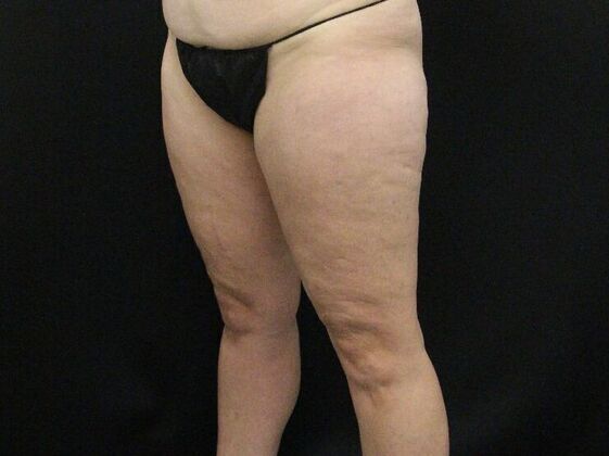 Thigh Lift: Case 9 - Before