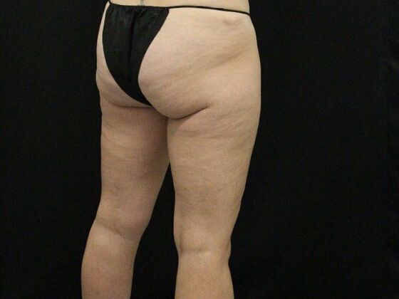 Thigh Lift: Case 9 - After