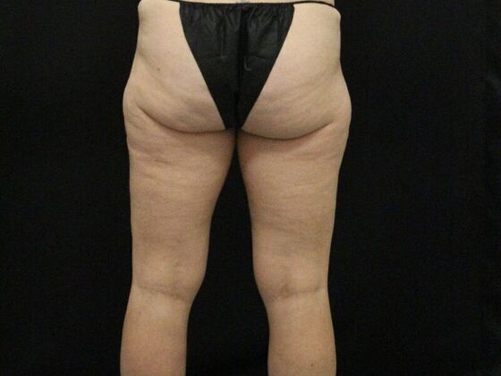Thigh Lift Case 9 - After