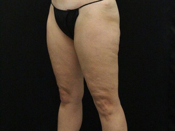 Thigh Lift: Case 9 - After