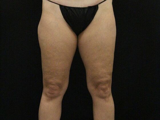 Thigh Lift: Case 9 - After